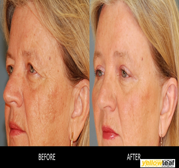 Brow Lift Surgery