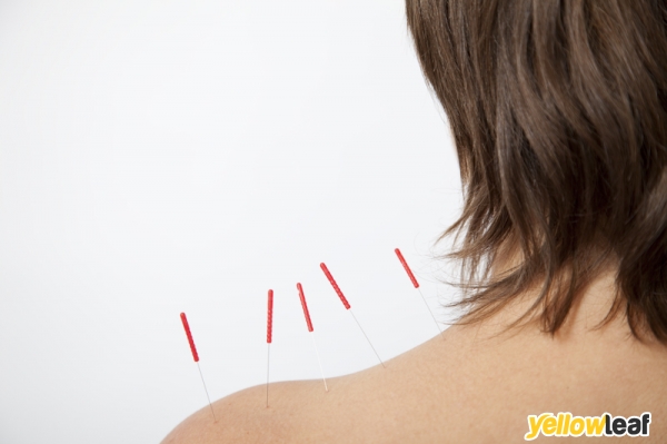 Acupuncture South Devon