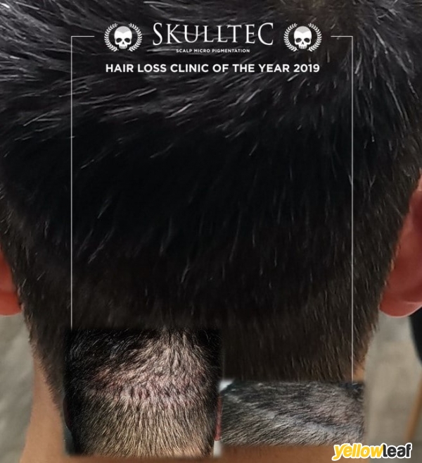 Scalp Micro Pigmentation by Skulltec
