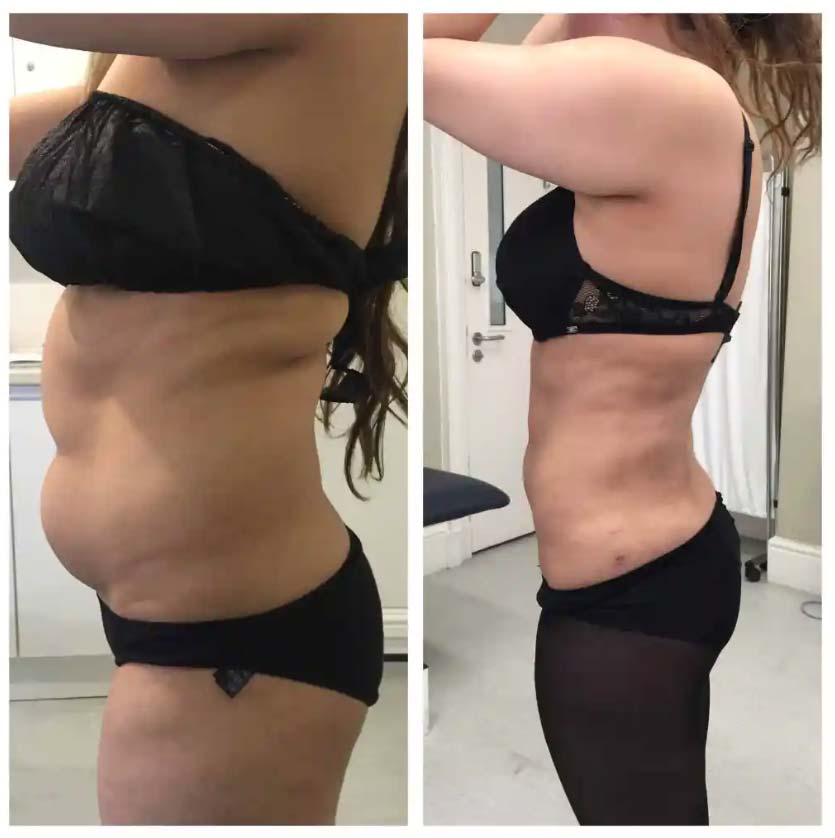 Vaser Lipo Centre