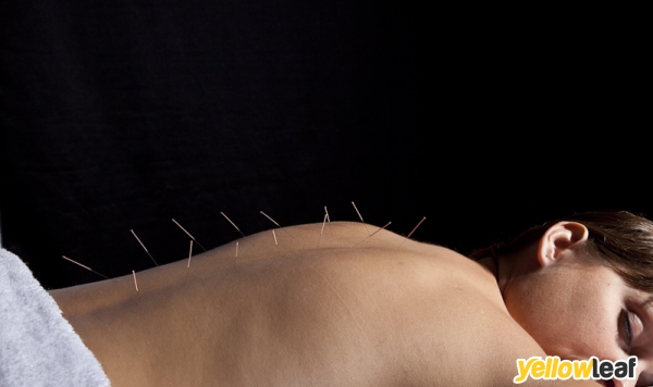 Acupuncture South Devon