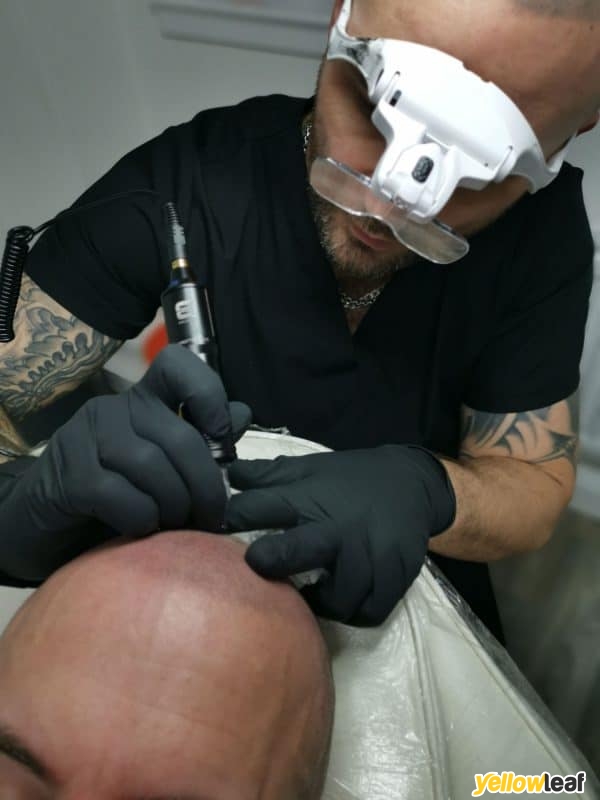 Scalp Micro Pigmentation by Skulltec