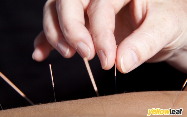 Acupuncture South Devon