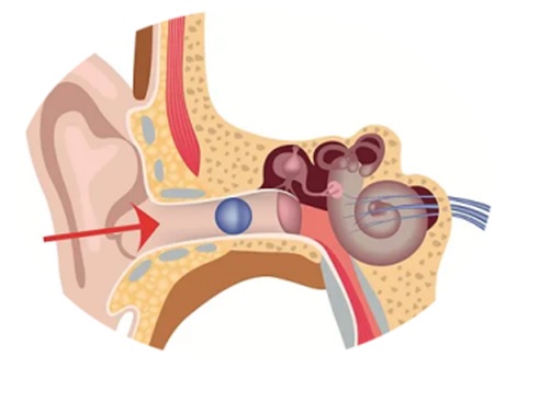 Ear Wax Solution Epsom