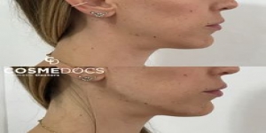 Jawline Filler