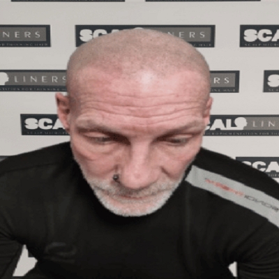 Scalpliners Scalp Micropigmentaion Kent